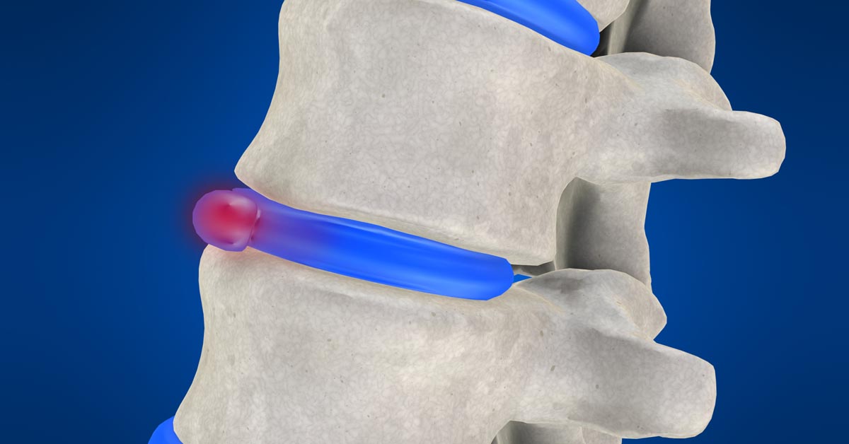 Spinal decompression therapy in Harleysville, PA