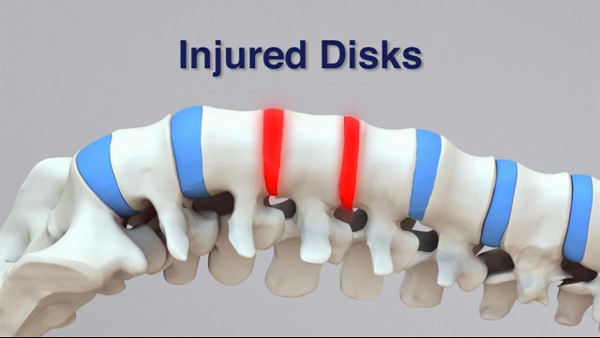 Harleysville, PA non-surgical spinal decompression